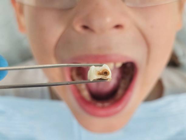 Best Broken or Cracked Tooth Emergency Dentist in Wild Peach Village, TX